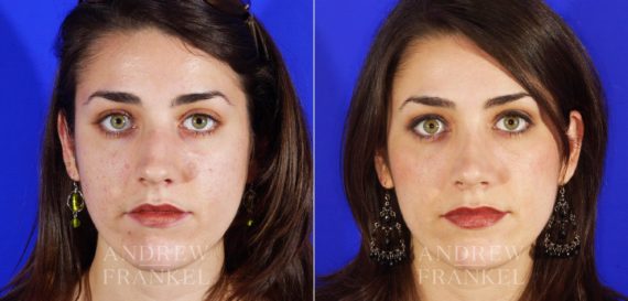 Rhinoplasty before and after photos in Beverly Hills, CA, Patient 5706