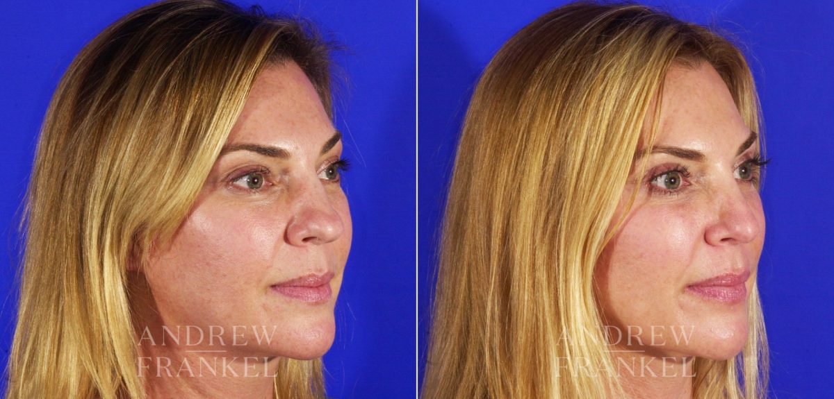 Rhinoplasty before and after photos in Beverly Hills, CA, Patient 5732