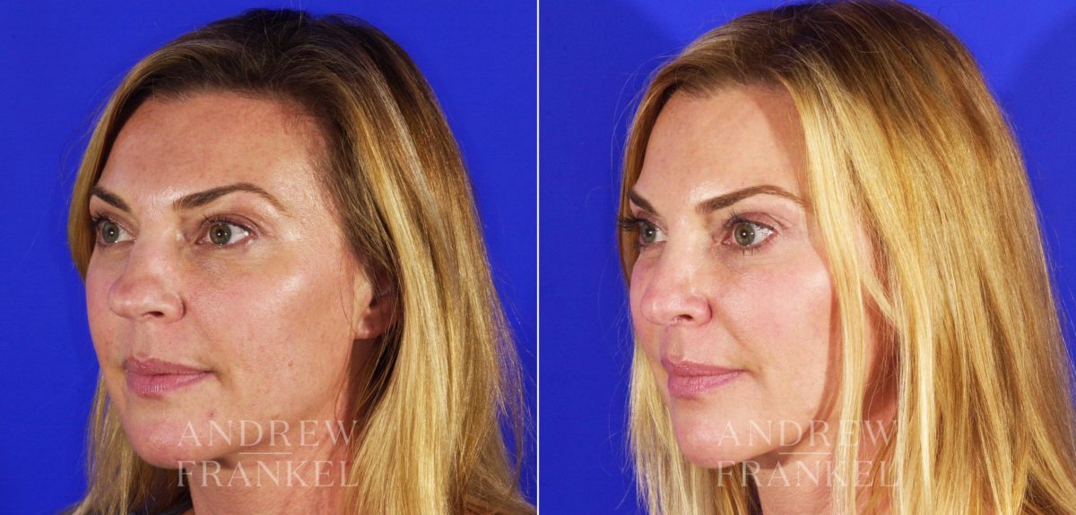 Rhinoplasty before and after photos in Beverly Hills, CA, Patient 5732