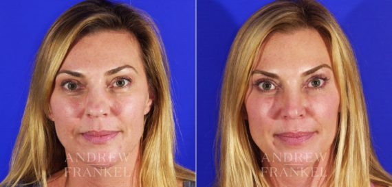 Rhinoplasty before and after photos in Beverly Hills, CA, Patient 5732
