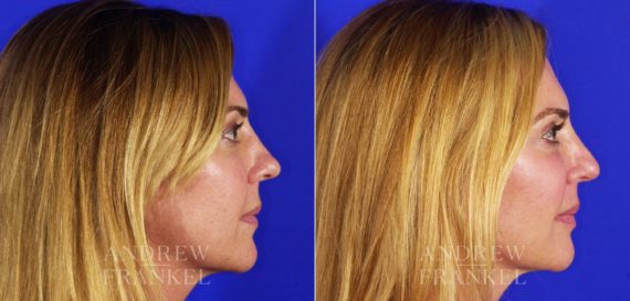 Rhinoplasty before and after photos in Beverly Hills, CA, Patient 5732