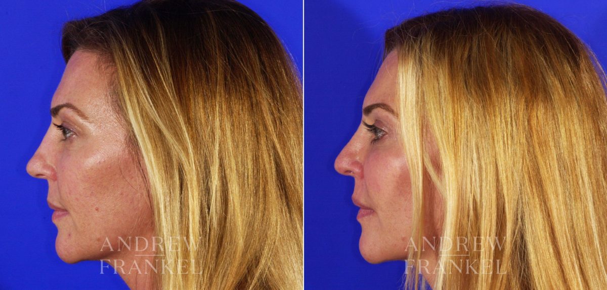 Rhinoplasty before and after photos in Beverly Hills, CA, Patient 5732