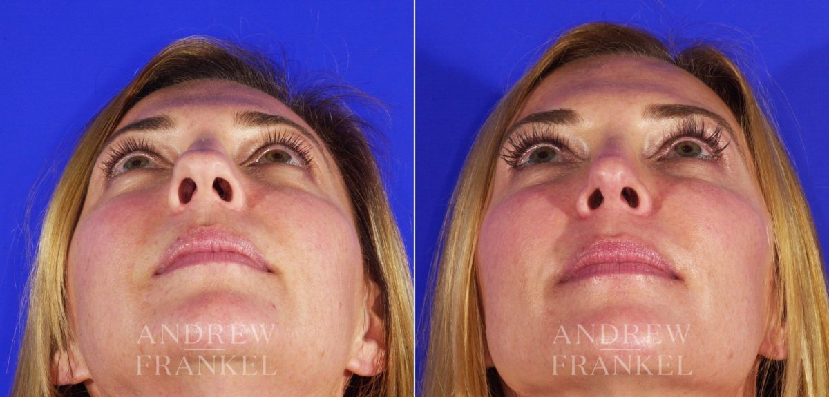 Rhinoplasty before and after photos in Beverly Hills, CA, Patient 5732