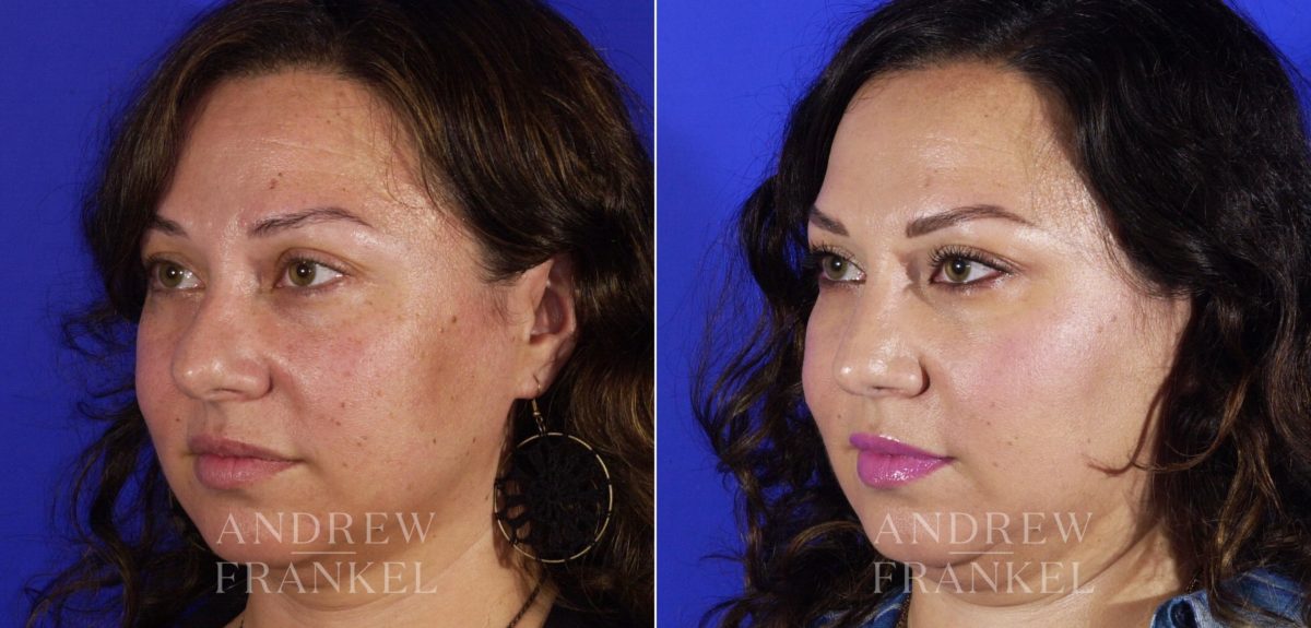 Rhinoplasty before and after photos in Beverly Hills, CA, Patient 5762