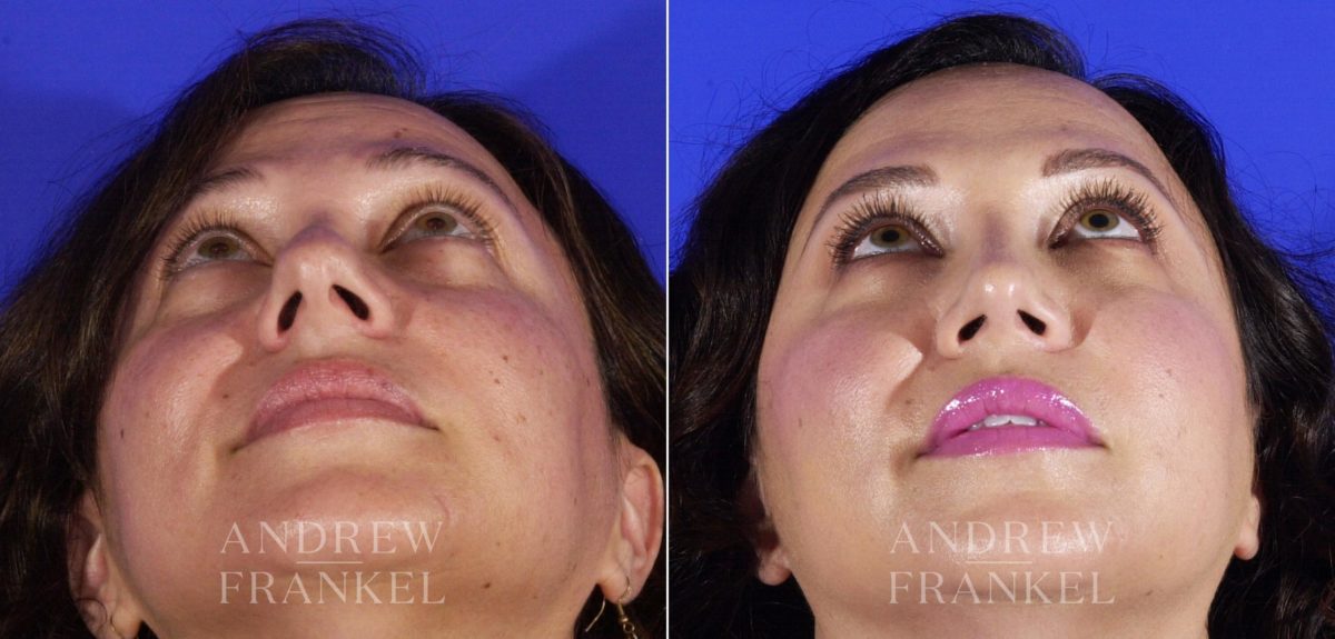 Rhinoplasty before and after photos in Beverly Hills, CA, Patient 5762
