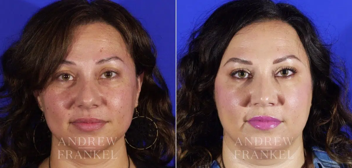 Rhinoplasty before and after photos in Beverly Hills, CA, Patient 5762