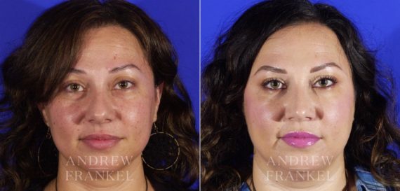 Rhinoplasty before and after photos in Beverly Hills, CA, Patient 5762