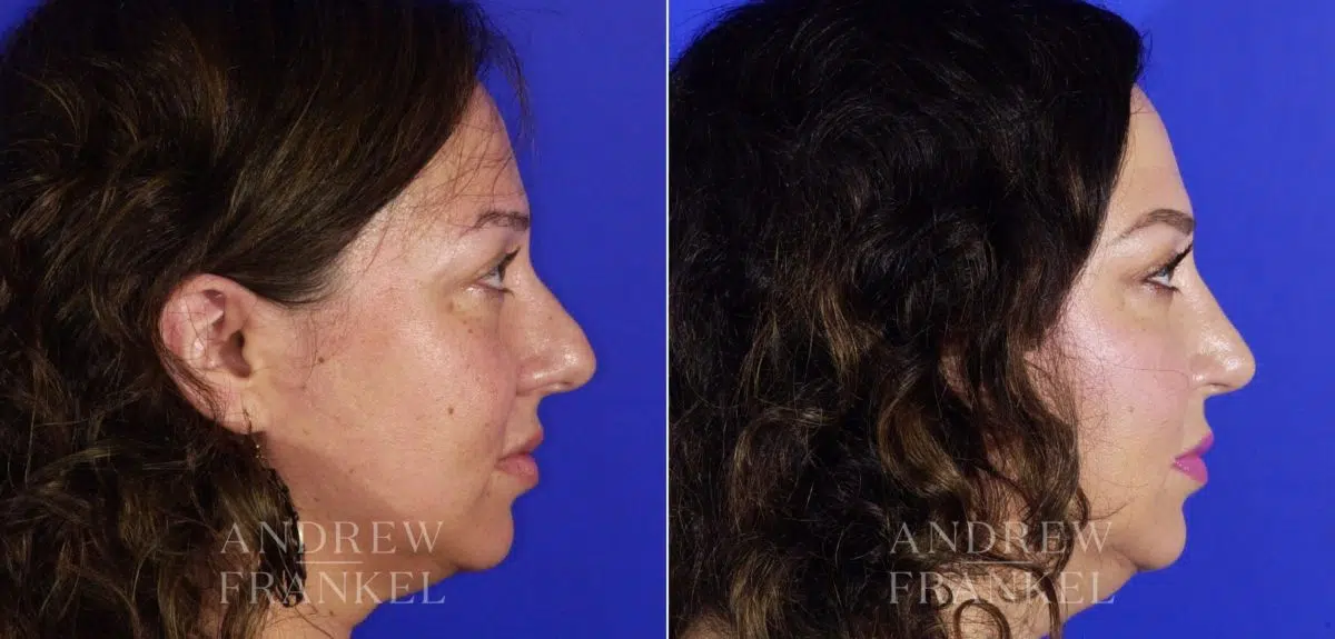 Rhinoplasty before and after photos in Beverly Hills, CA, Patient 5762