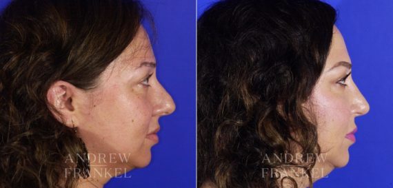 Rhinoplasty before and after photos in Beverly Hills, CA, Patient 5762