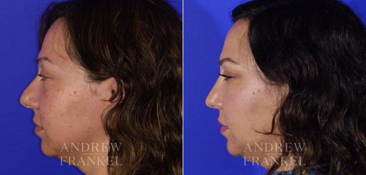 Rhinoplasty before and after photos in Beverly Hills, CA, Patient 5762