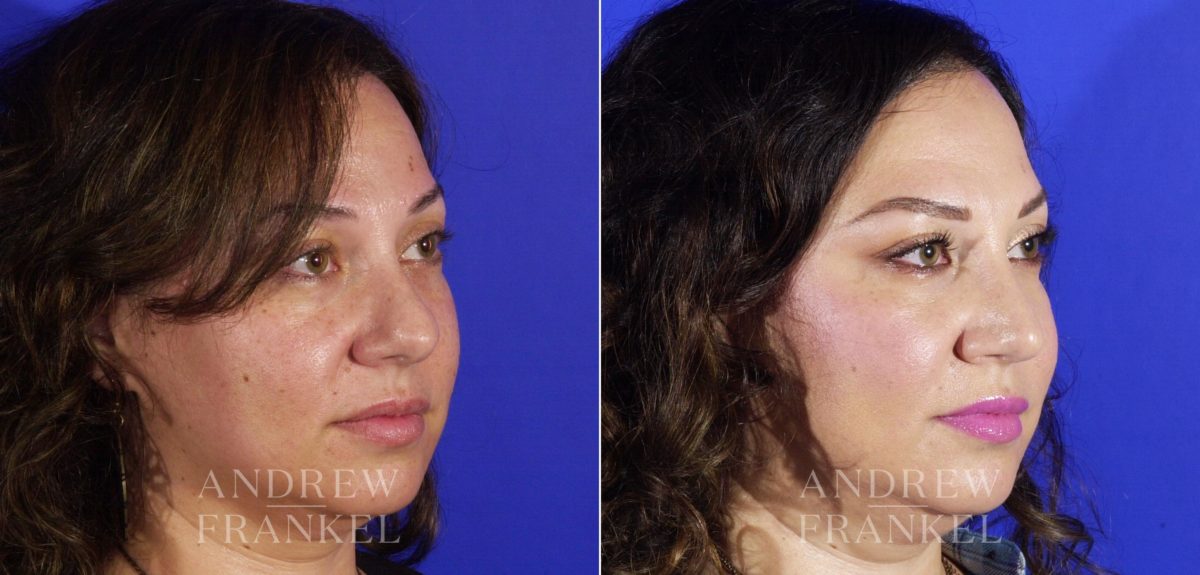 Rhinoplasty before and after photos in Beverly Hills, CA, Patient 5762
