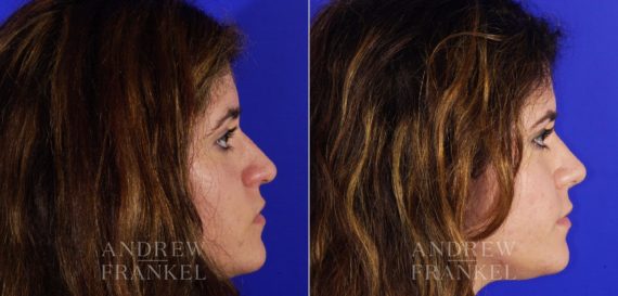 Rhinoplasty before and after photos in Beverly Hills, CA, Patient 6001