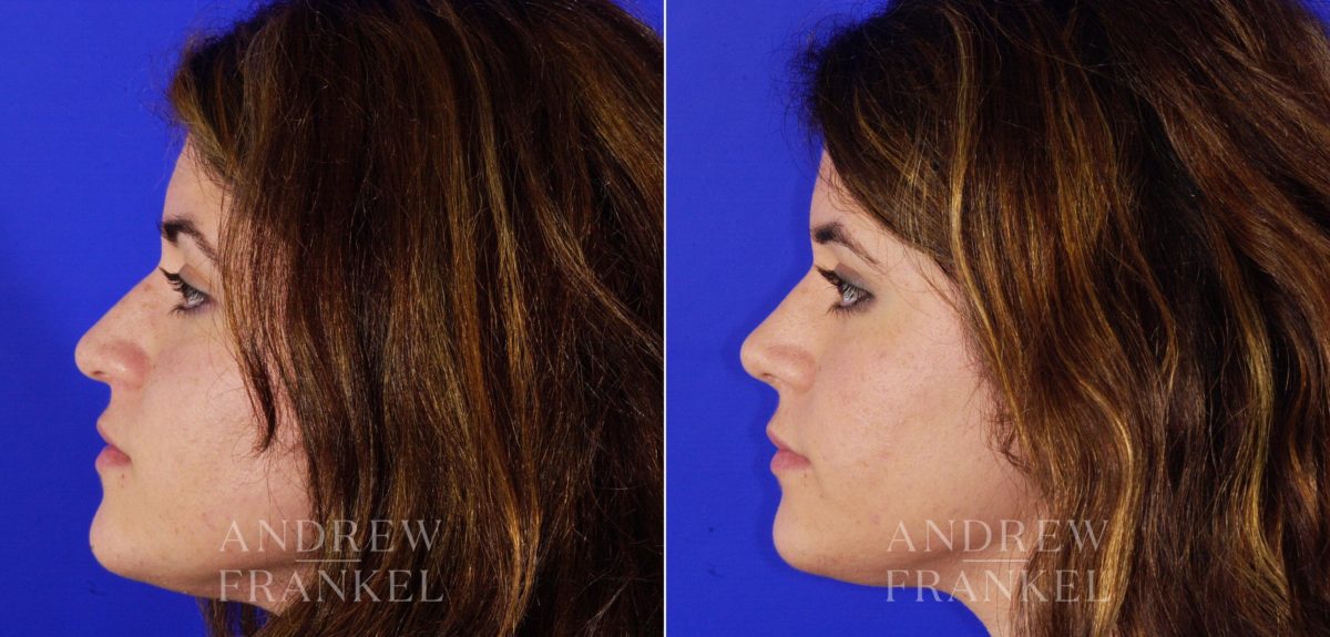 Rhinoplasty before and after photos in Beverly Hills, CA, Patient 6001