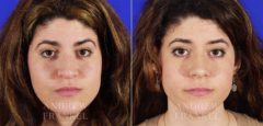 Rhinoplasty before and after photos in Beverly Hills, CA, Patient 6001