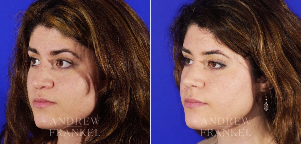 Rhinoplasty before and after photos in Beverly Hills, CA, Patient 6001