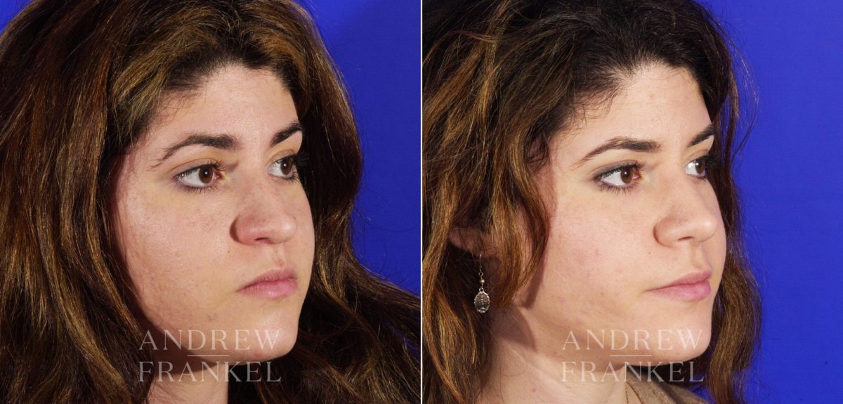 Rhinoplasty before and after photos in Beverly Hills, CA, Patient 6001