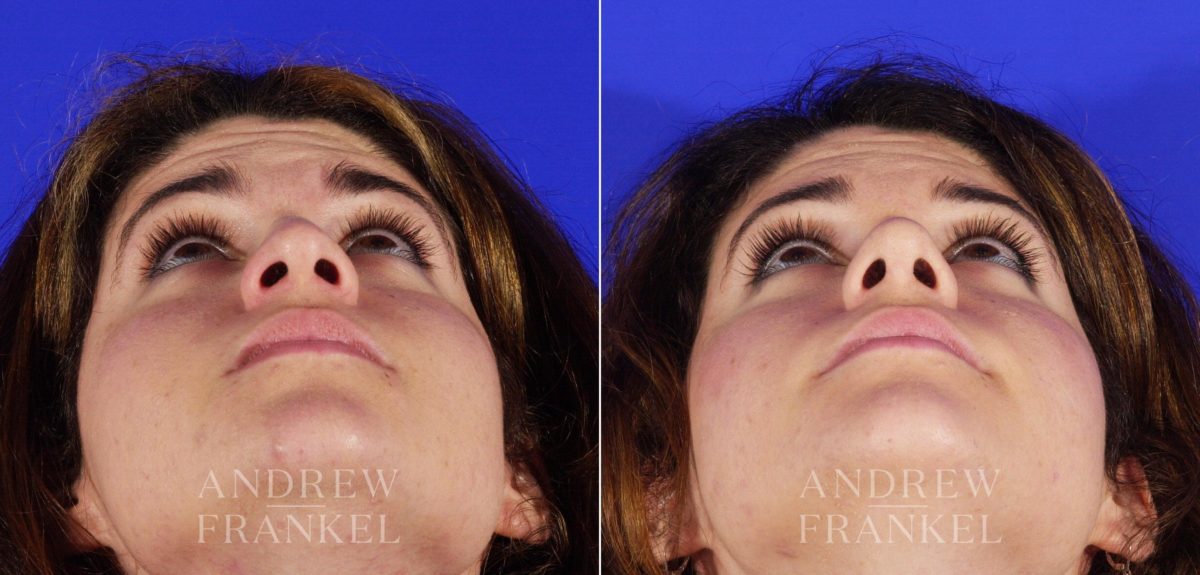 Rhinoplasty before and after photos in Beverly Hills, CA, Patient 6001