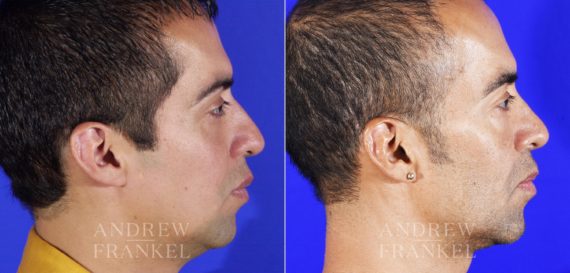 Rhinoplasty before and after photos in Beverly Hills, CA, Patient 6014