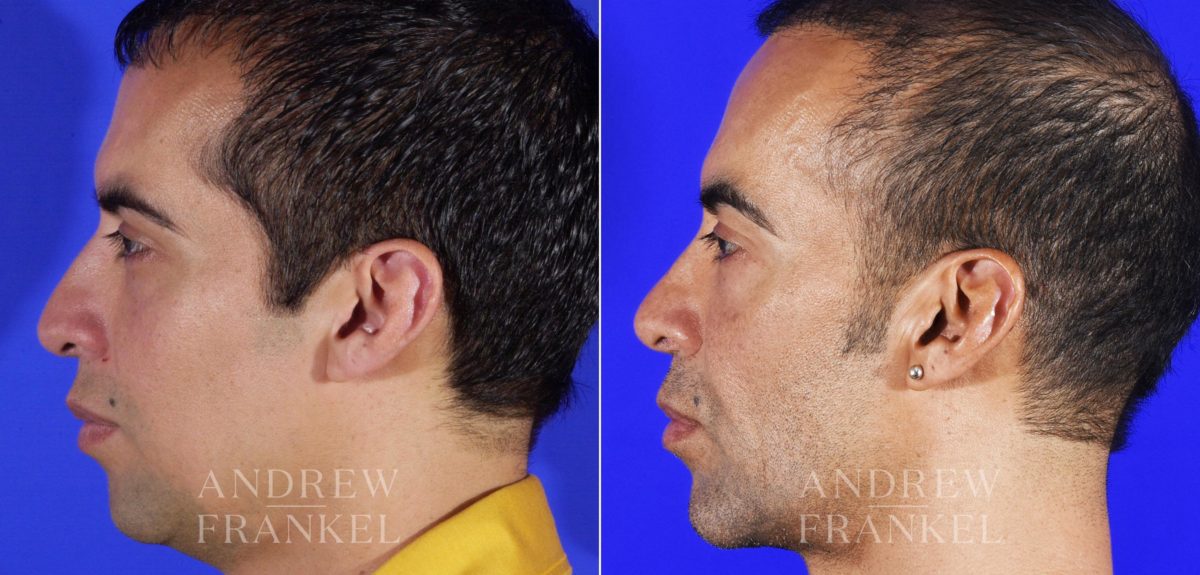 Rhinoplasty before and after photos in Beverly Hills, CA, Patient 6014