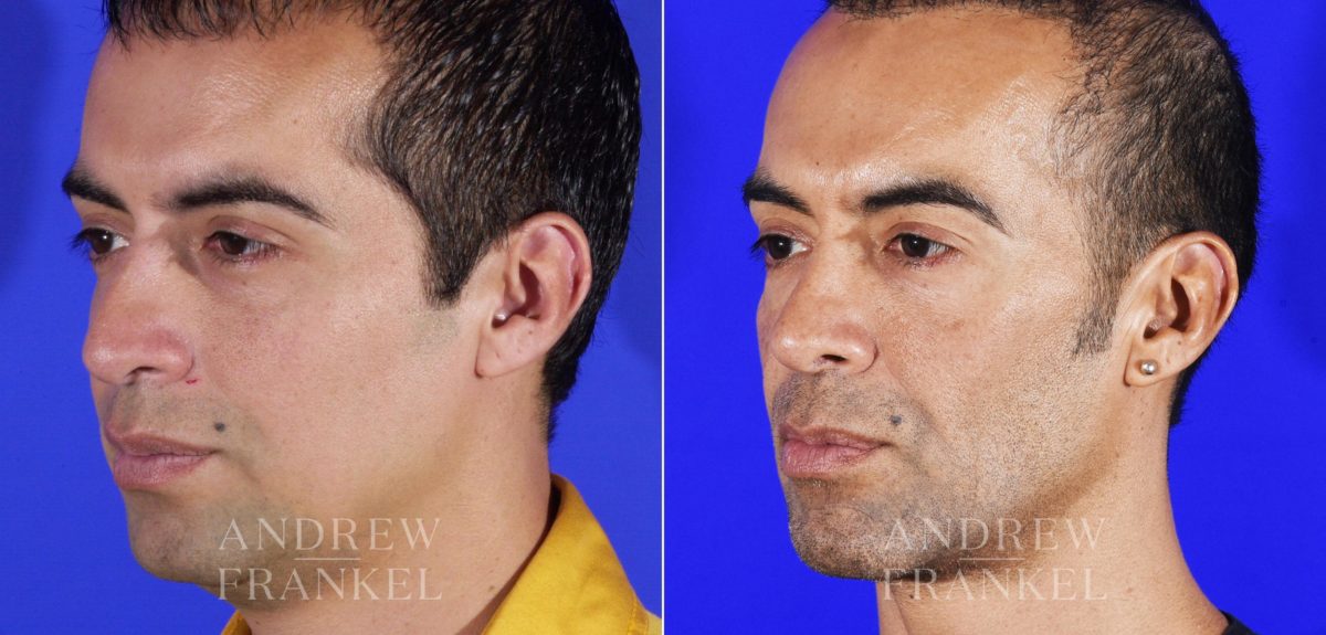 Rhinoplasty before and after photos in Beverly Hills, CA, Patient 6014