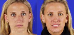 Rhinoplasty before and after photos in Beverly Hills, CA, Patient 6026