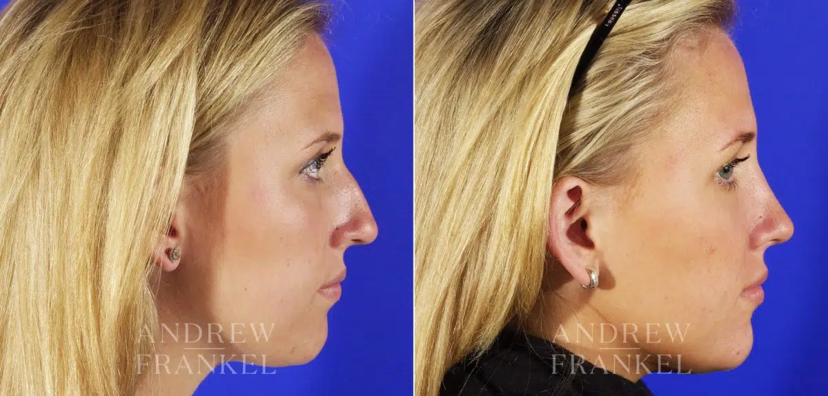 Rhinoplasty before and after photos in Beverly Hills, CA, Patient 6026