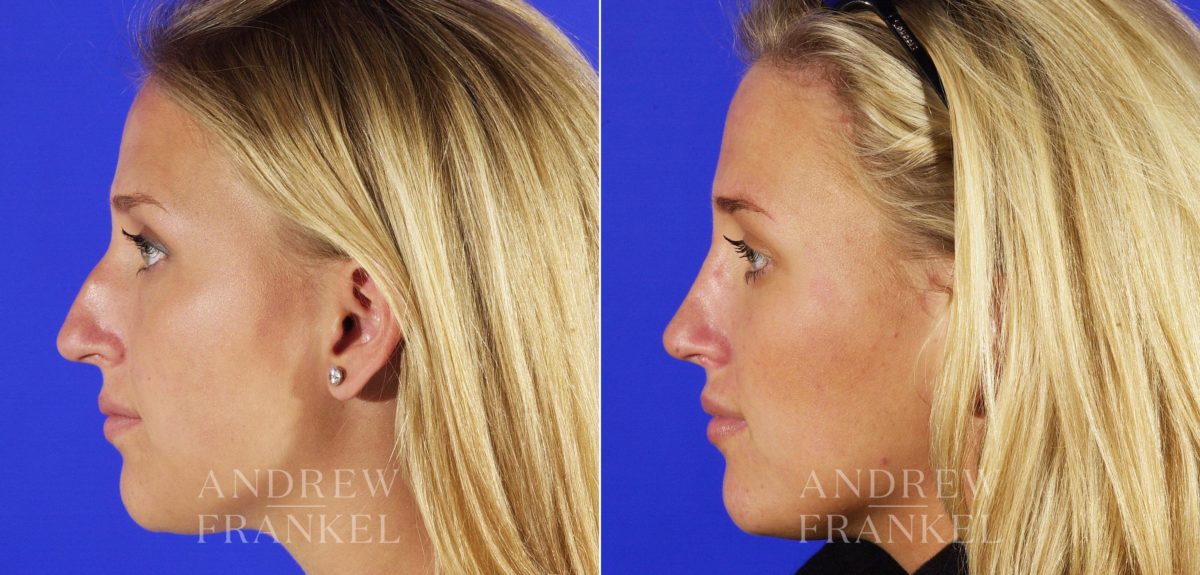 Rhinoplasty before and after photos in Beverly Hills, CA, Patient 6026