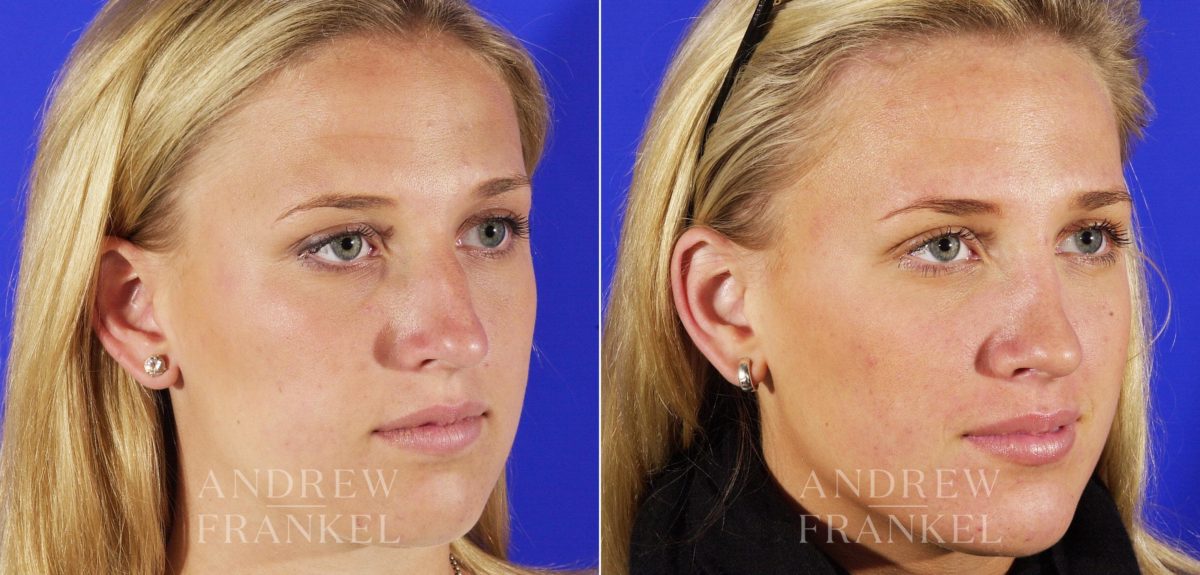 Rhinoplasty before and after photos in Beverly Hills, CA, Patient 6026
