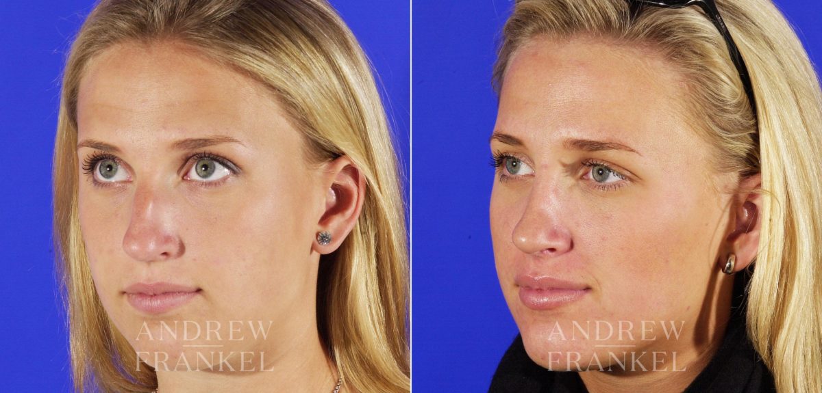 Rhinoplasty before and after photos in Beverly Hills, CA, Patient 6026