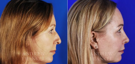 Rhinoplasty before and after photos in Beverly Hills, CA, Patient 6040