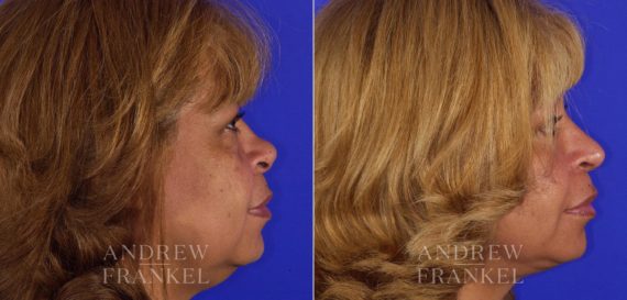 Rhinoplasty before and after photos in Beverly Hills, CA, Patient 6051