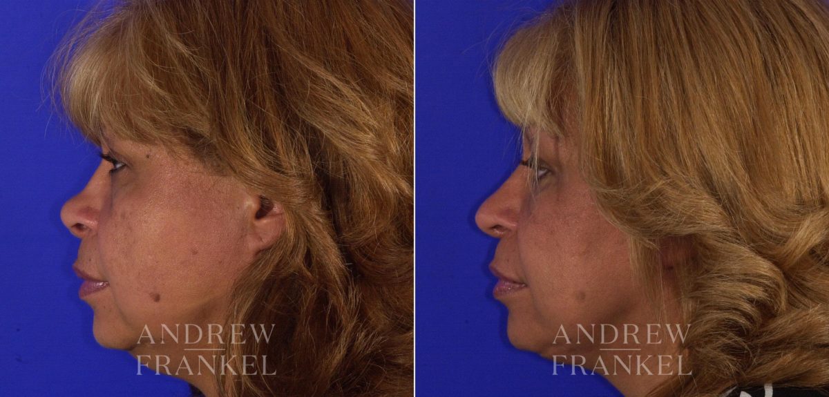 Rhinoplasty before and after photos in Beverly Hills, CA, Patient 6051