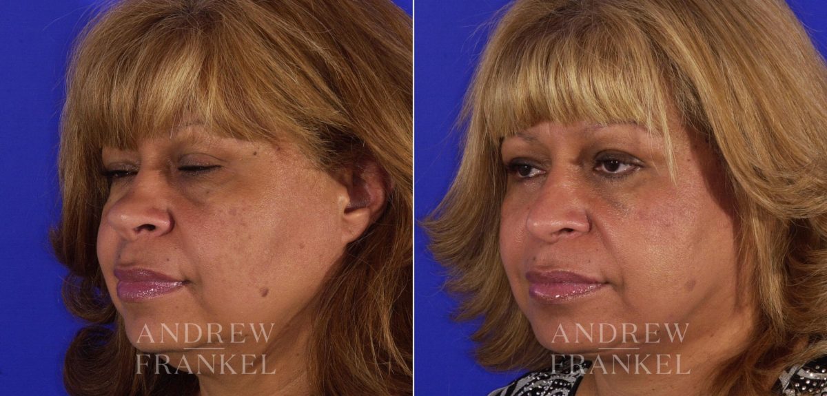Rhinoplasty before and after photos in Beverly Hills, CA, Patient 6051