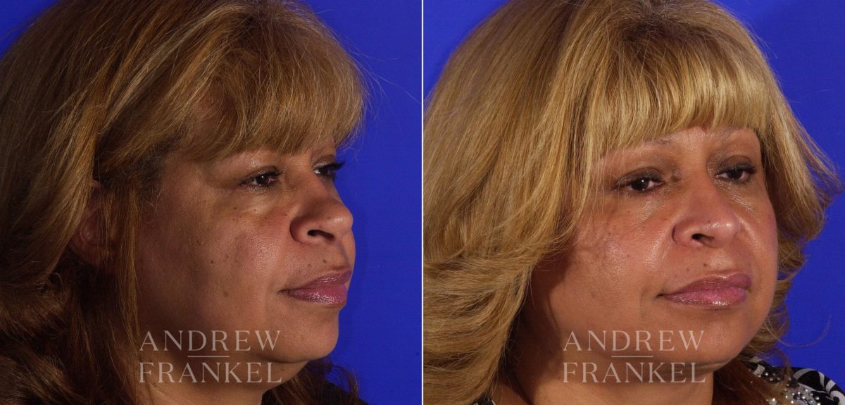 Rhinoplasty before and after photos in Beverly Hills, CA, Patient 6051