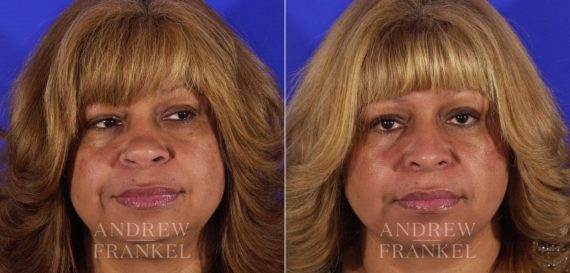 Rhinoplasty before and after photos in Beverly Hills, CA, Patient 6051