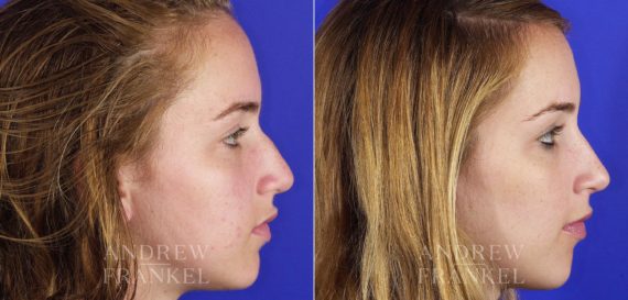 Rhinoplasty before and after photos in Beverly Hills, CA, Patient 6075