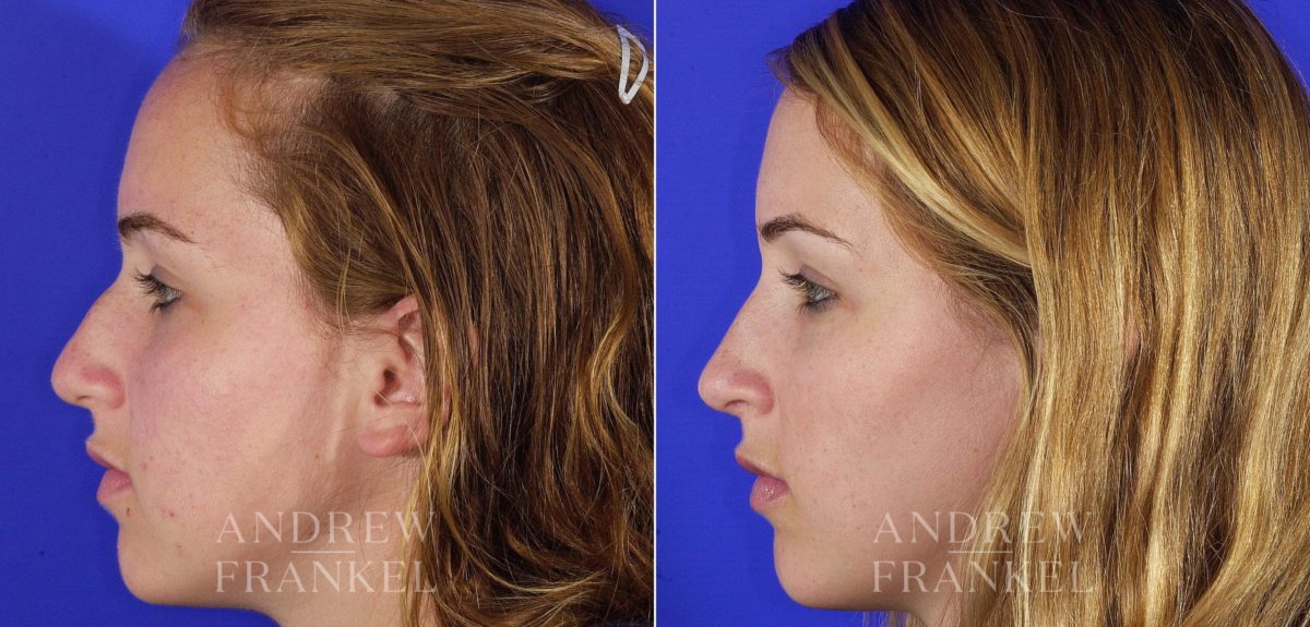 Rhinoplasty before and after photos in Beverly Hills, CA, Patient 6075