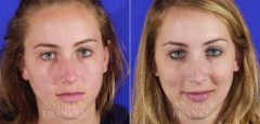 Rhinoplasty before and after photos in Beverly Hills, CA, Patient 6075