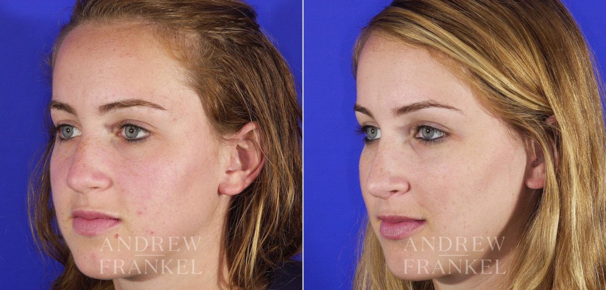 Rhinoplasty before and after photos in Beverly Hills, CA, Patient 6075