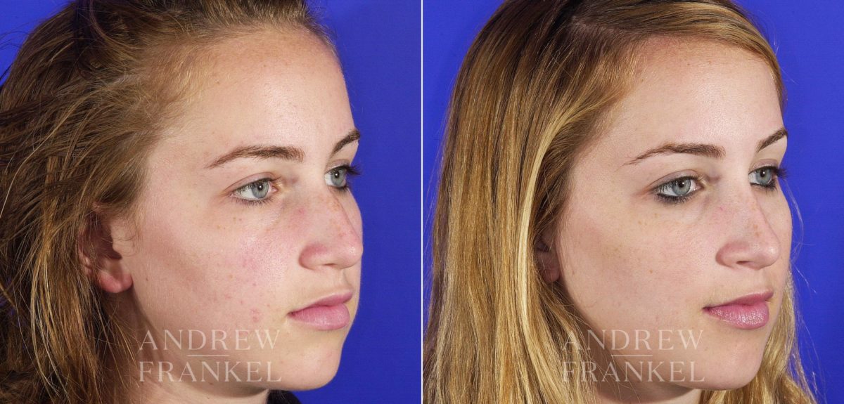 Rhinoplasty before and after photos in Beverly Hills, CA, Patient 6075