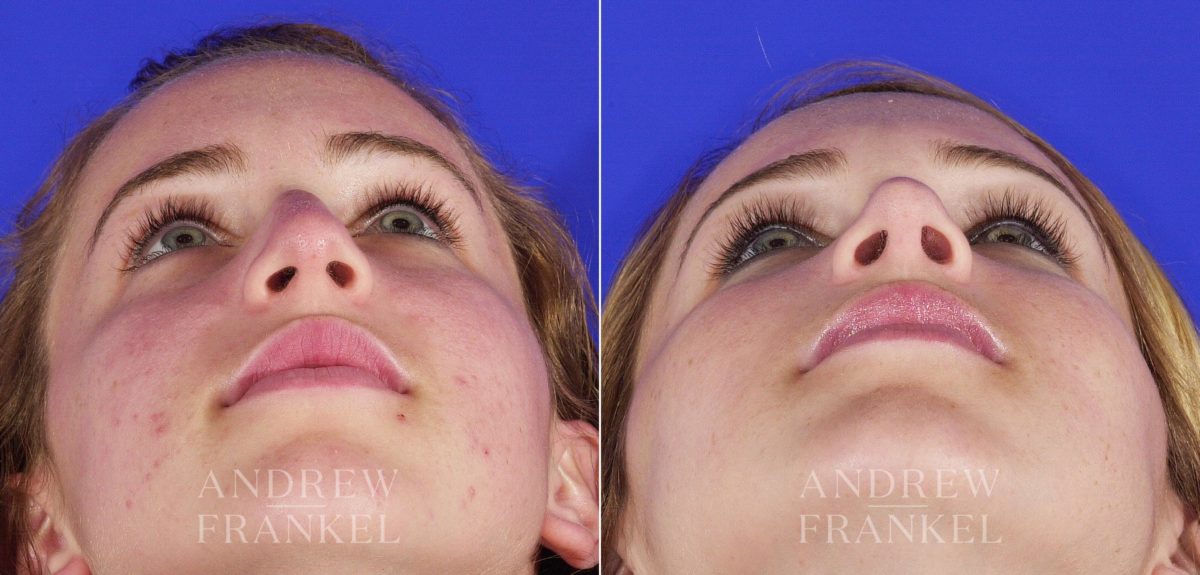 Rhinoplasty before and after photos in Beverly Hills, CA, Patient 6075