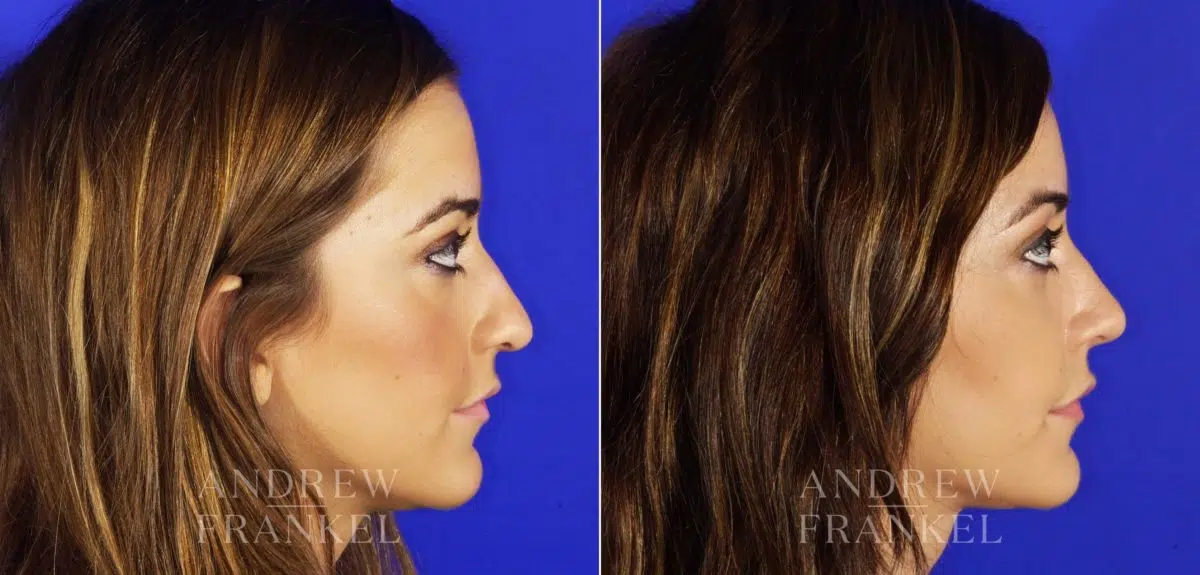 Rhinoplasty before and after photos in Beverly Hills, CA, Patient 6140