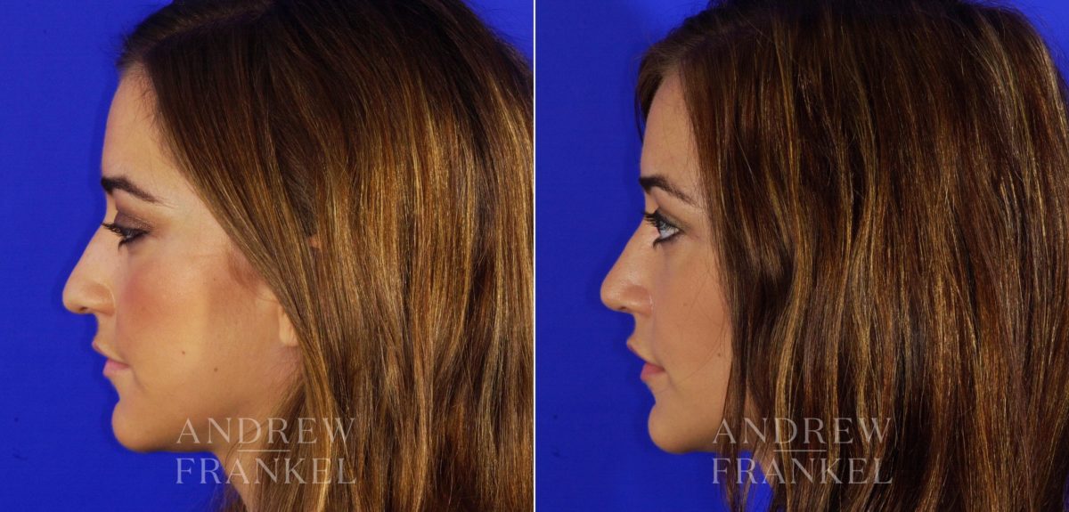 Rhinoplasty before and after photos in Beverly Hills, CA, Patient 6140