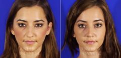 Rhinoplasty before and after photos in Beverly Hills, CA, Patient 6140