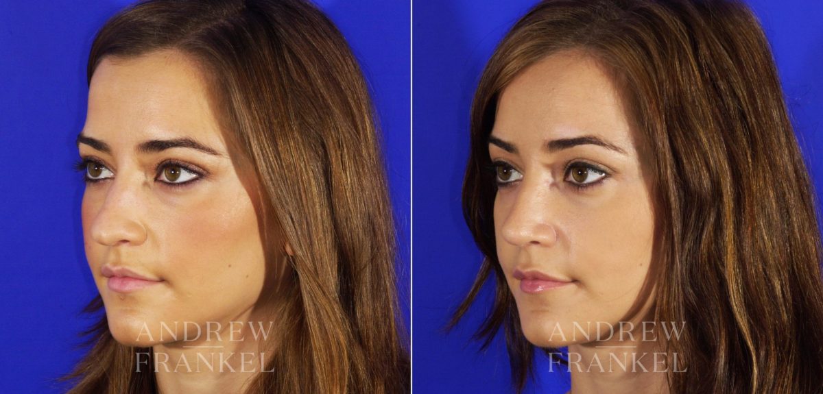 Rhinoplasty before and after photos in Beverly Hills, CA, Patient 6140