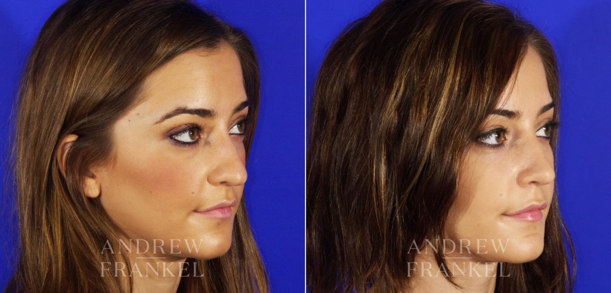 Rhinoplasty before and after photos in Beverly Hills, CA, Patient 6140