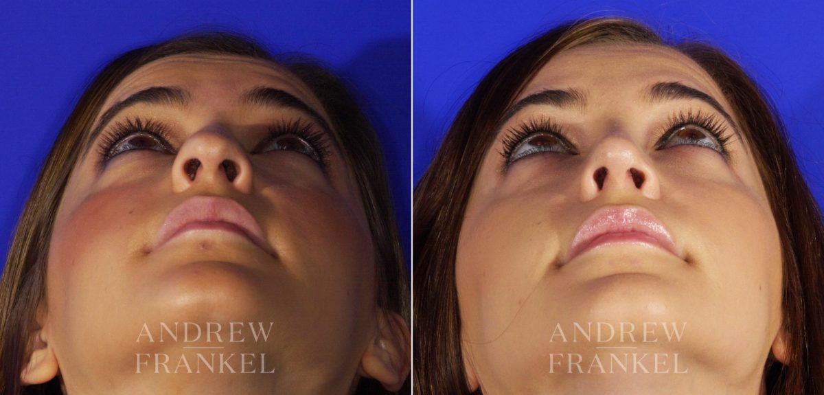 Rhinoplasty before and after photos in Beverly Hills, CA, Patient 6140