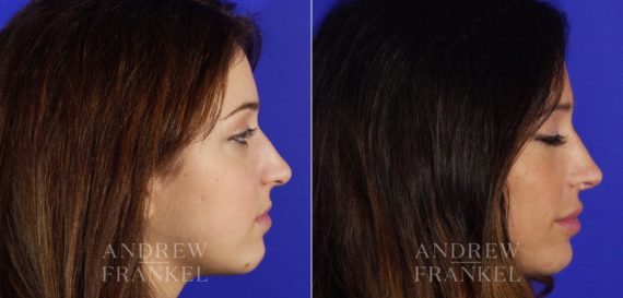 Rhinoplasty before and after photos in Beverly Hills, CA, Patient 6149