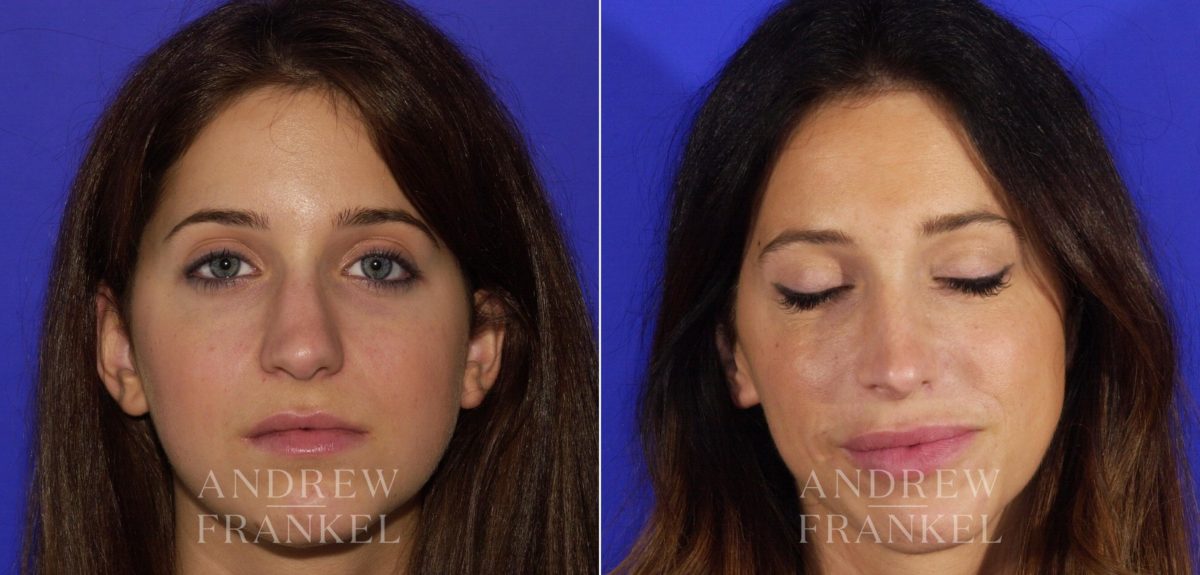 Rhinoplasty before and after photos in Beverly Hills, CA, Patient 6149