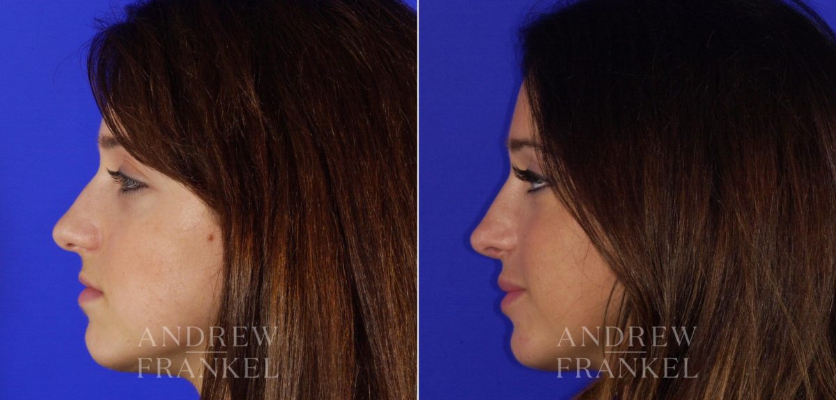 Rhinoplasty before and after photos in Beverly Hills, CA, Patient 6149